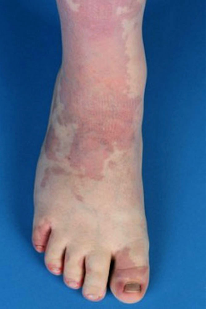 Kapilläre Malformation an Bein und Fuß