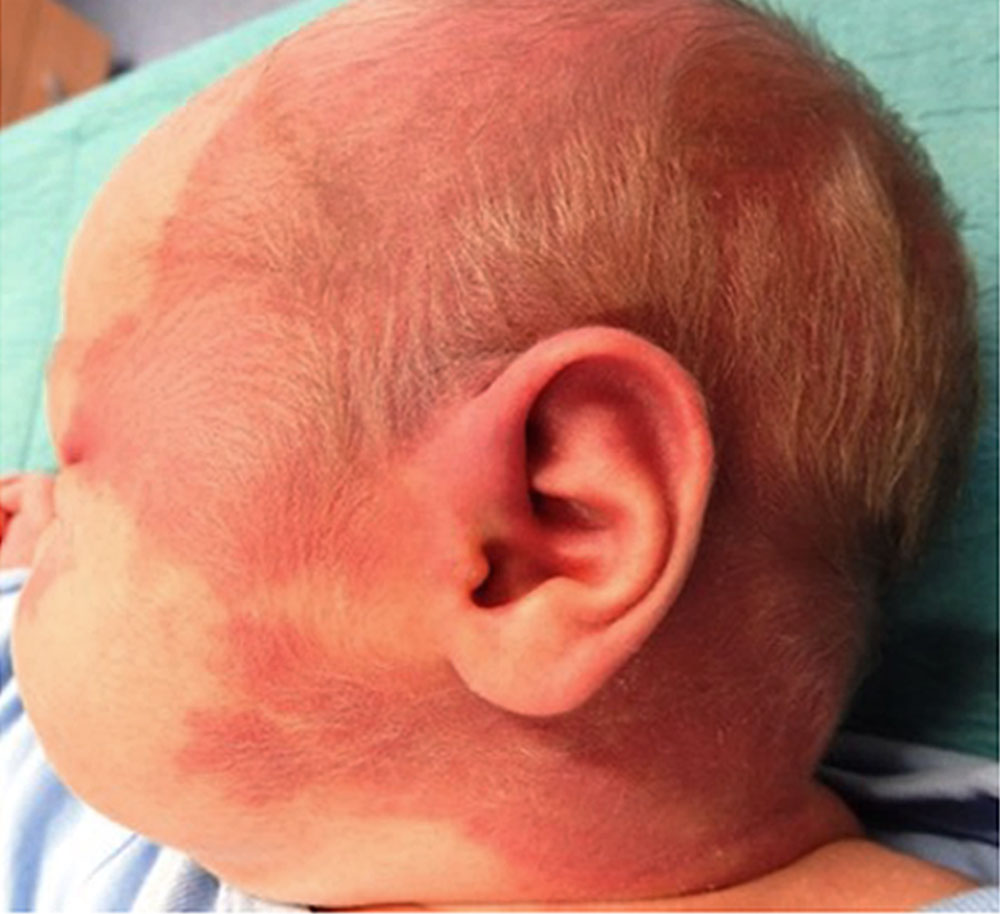 Kapilläre Malformation im Kopf-Halsbereich bei Säugling