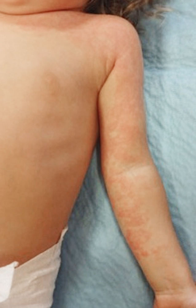 Kleinfleckige kapilläre Malformation bei Kleinkind