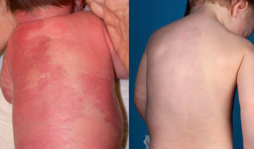 Verlauf mit Abblassung einer kapillären Malformation am Rücken