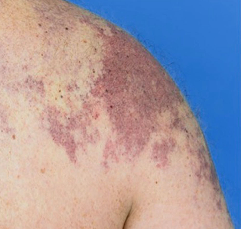 Farbänderung der kapillären Malformation nach Lebensalter