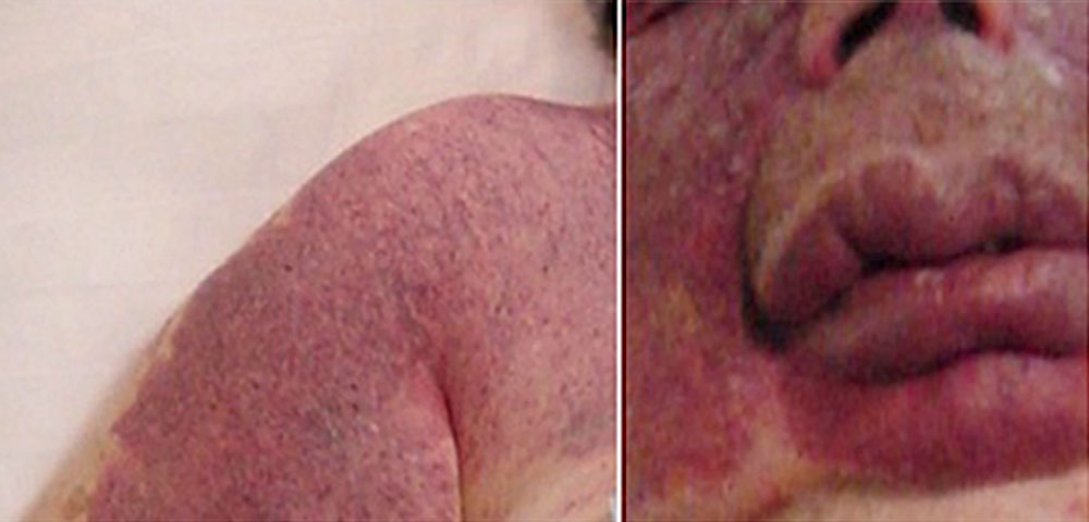 Kapilläre Malformation im Gesicht