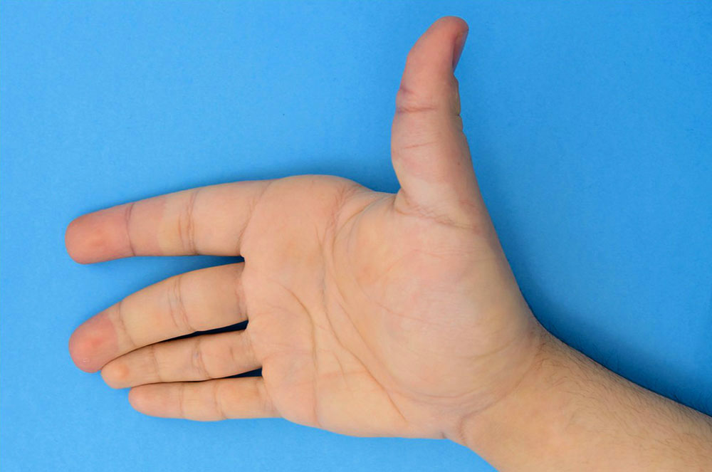 Hyperplasie an Hand bei CLOVES-Syndrom