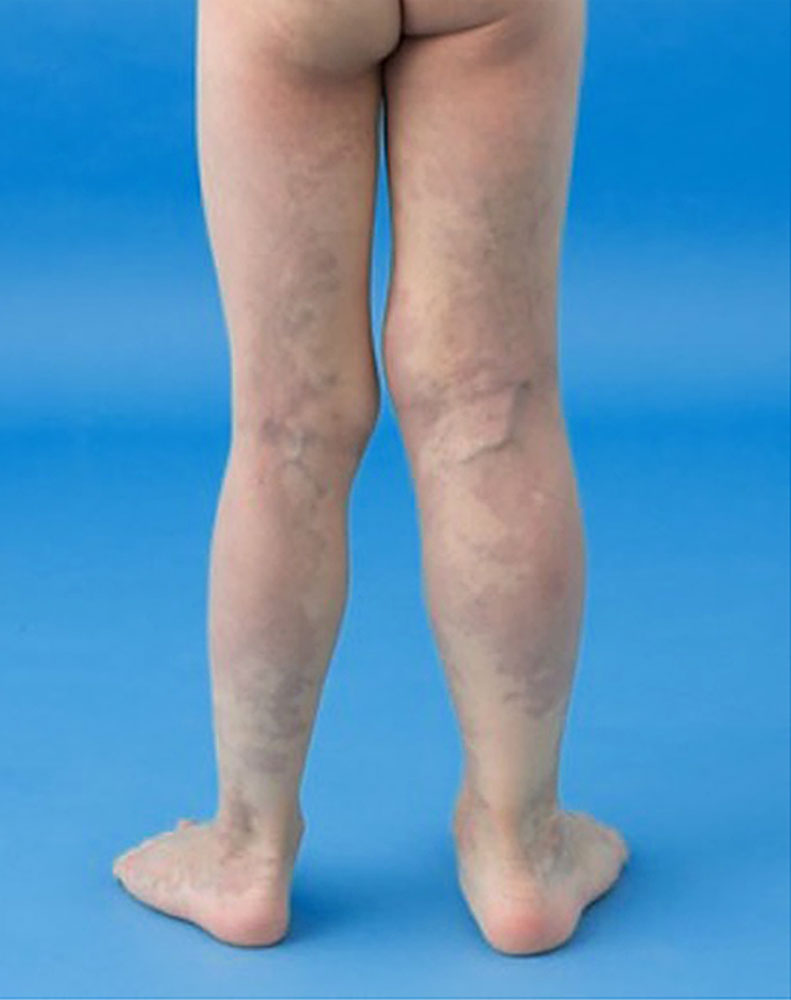 Klippel-Trénaunay-Syndrom der Beine