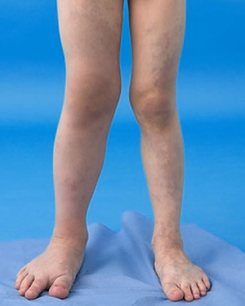 Klippel-Trénaunay-Syndrom der Beine