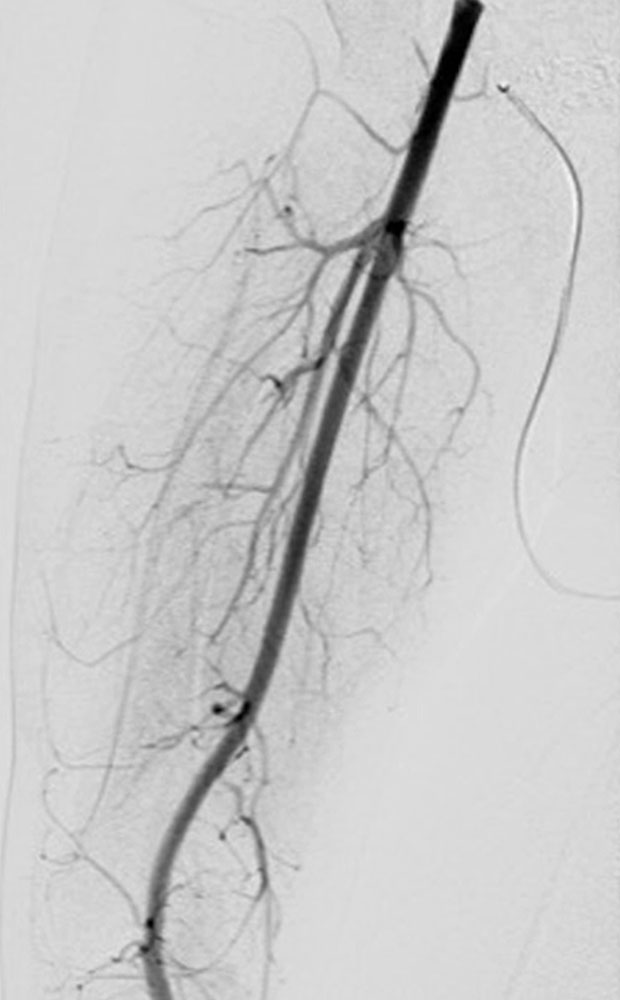 Arteriovenöse Fisteln bei Parkes-Weber-Syndrom