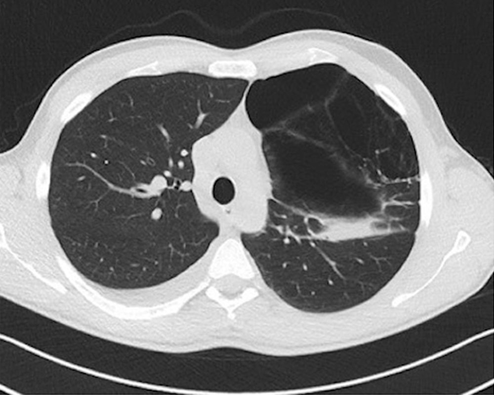 Computertomographie Lungenzysten bei Proteus-Syndrom