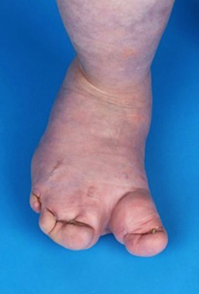 Hyperplasie des Fußes bei CLOVES-Syndrom