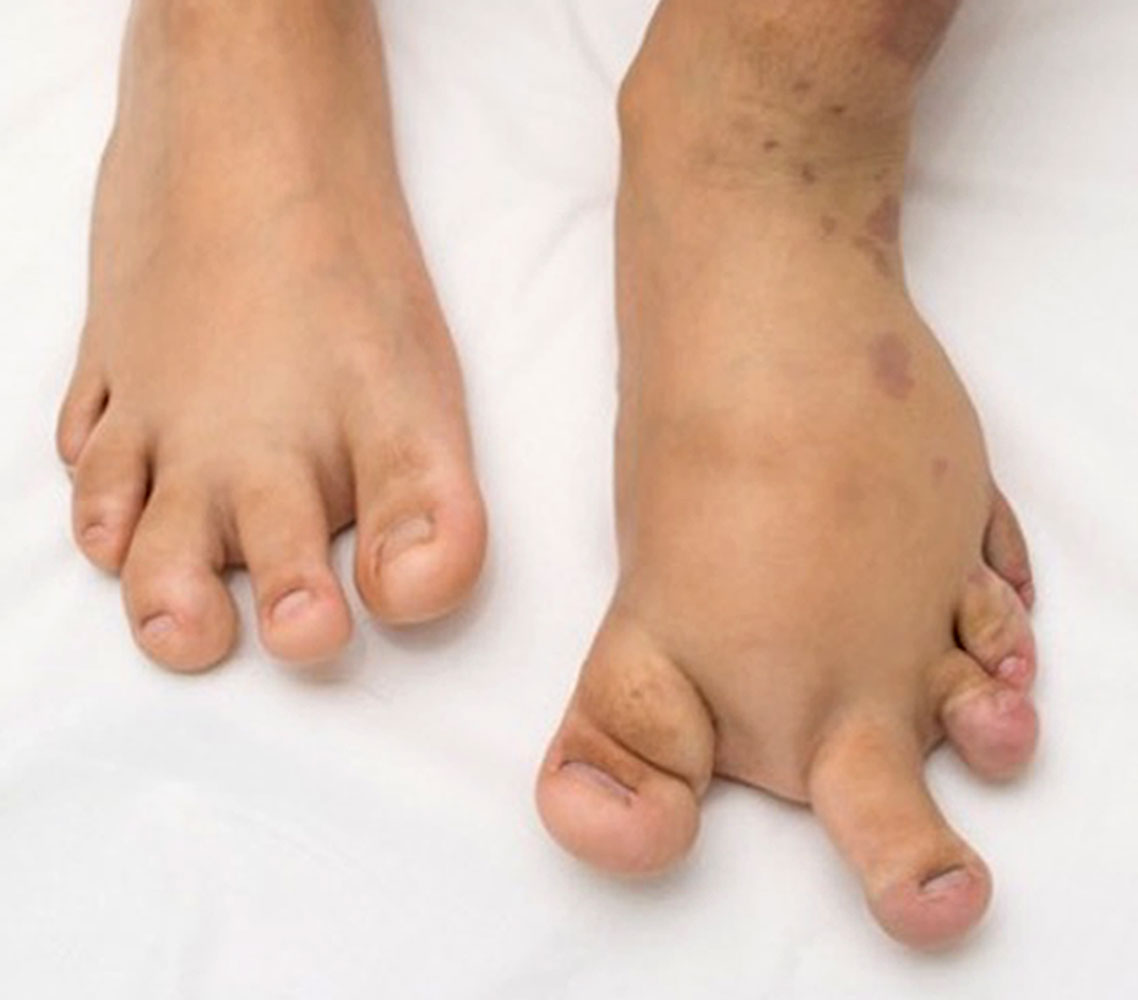 Hyperplasie der Füße bei CLOVES-Syndrom