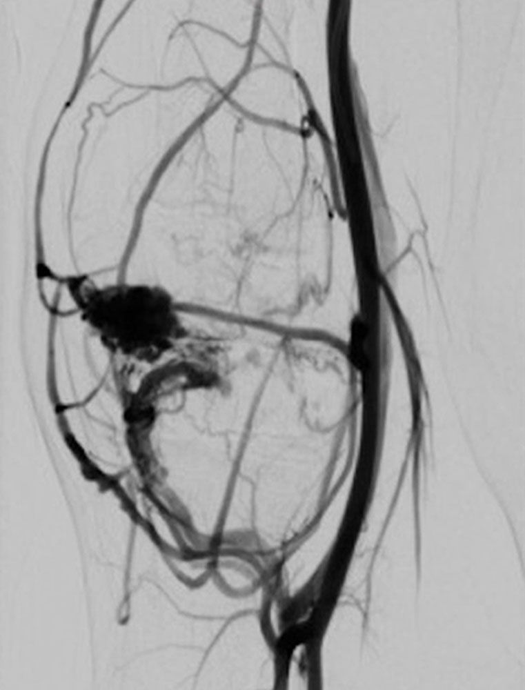 Digitale Subtraktionsangiographie - Knie bei PTEN-hamartoma Syndrom