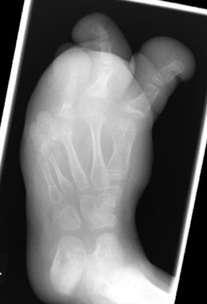 Röntgenbild eines Fußes bei CLOVES-Syndrom mit Großwachstum
