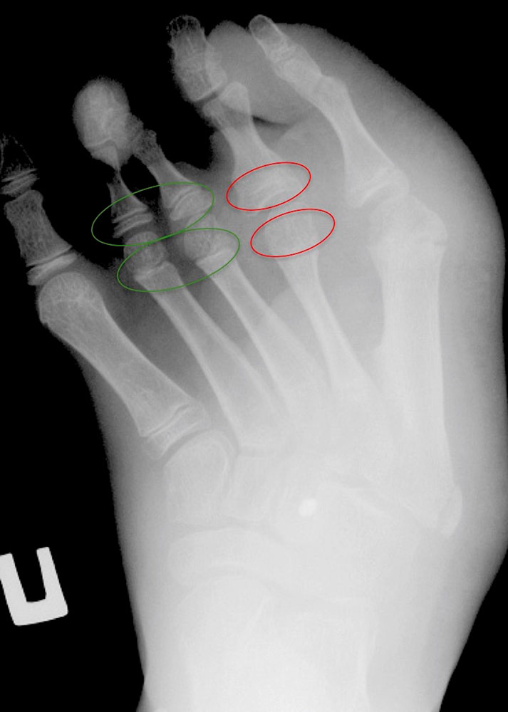 Röntgenbild von disproportioniertem Überwachstum des Fußes