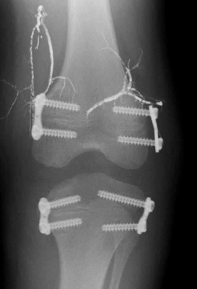 Röntgenbild – Temporäre Epiphysiodese
