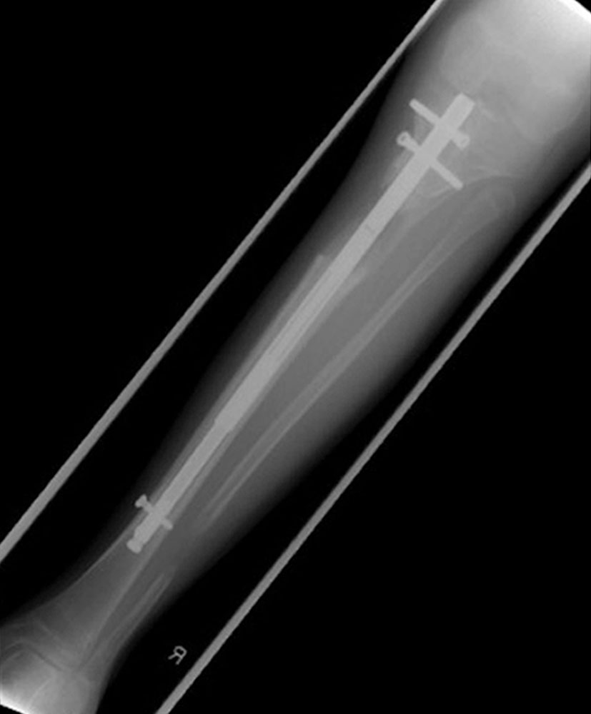 Röntgenbild eines motorbetriebenen Verlängerungsnagels in Tibia
