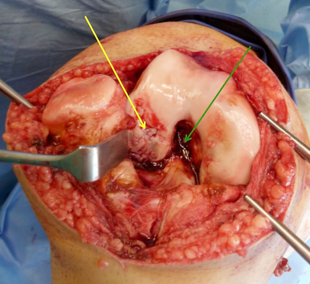 Operation – Knorpelschädigung Knie