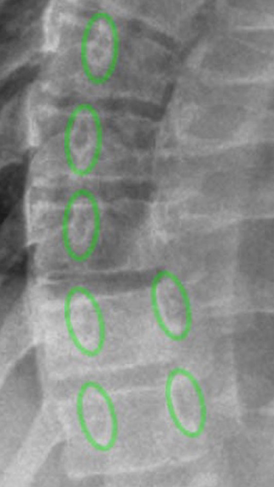 Röntgenbild – Rotation der Wirbelkörper