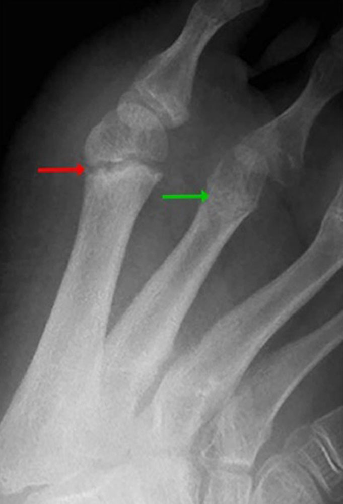 Röntgenbild – Wachstumsfuge Fußknochen