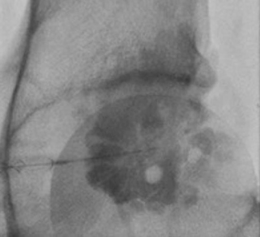Röntgenbild – Thromben innerhalb einer venösen Malformation