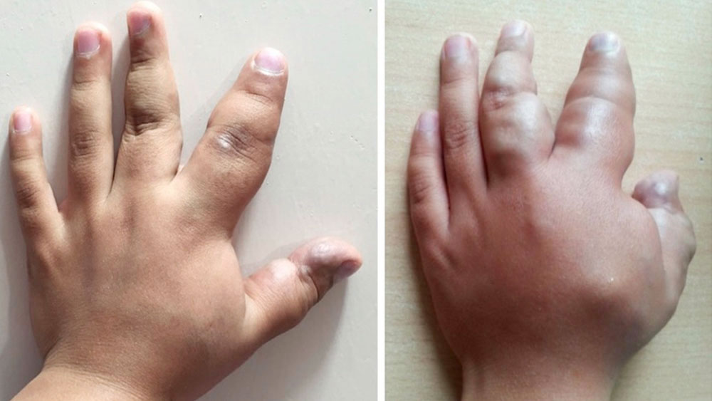 Ausgedehnte venöse Malformation an Hand bei akuter Thrombophlebitis
