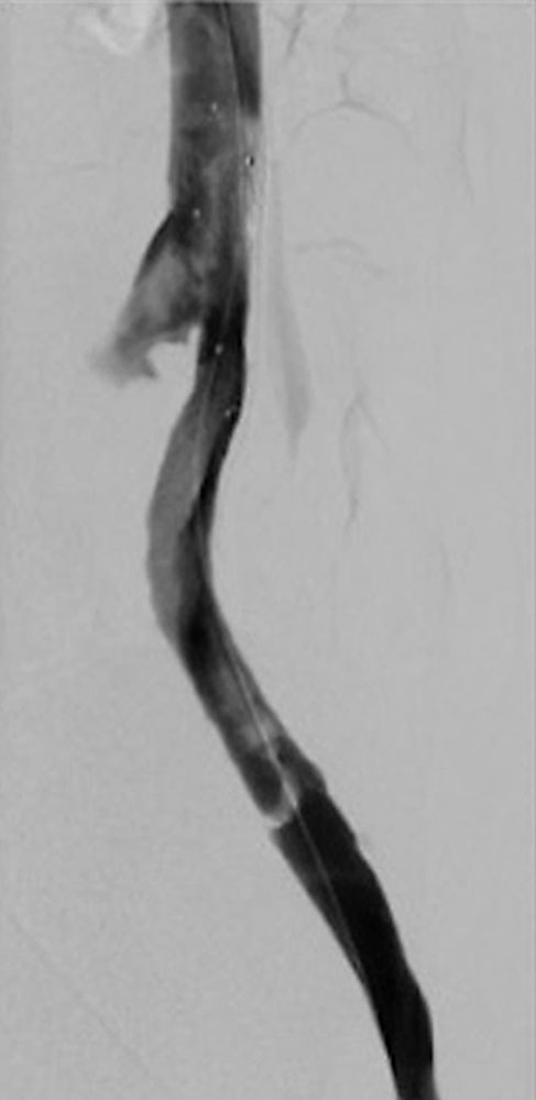 Digitale Subtraktionsphlebographie – Thrombose der linken Beckenvene