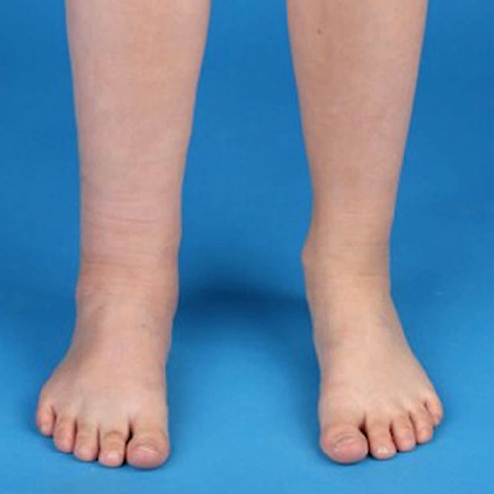 Phlebothrombose Bein bei venöser Malformation