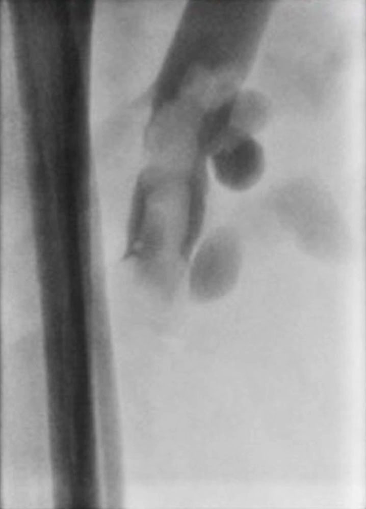 Phlebographie von Bein mit großem Thrombus