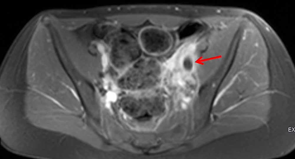 MRT – Thrombose der linken Vena iliaca externa