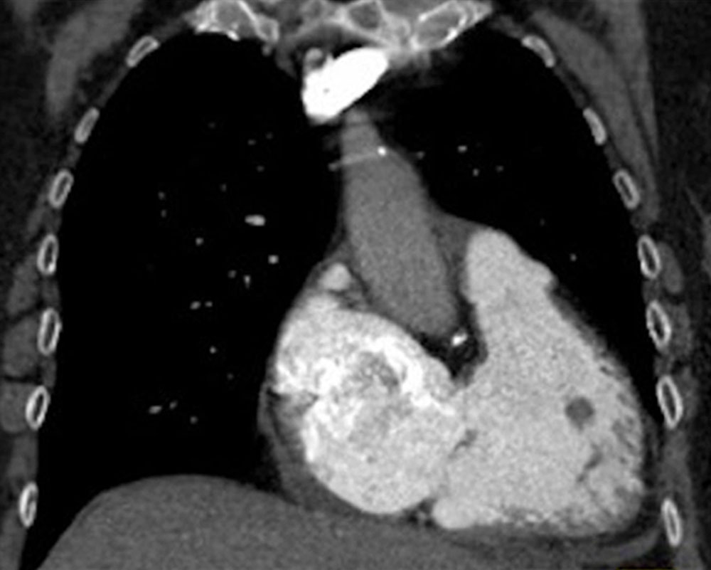 CT-Angiographie von Lungenembolie