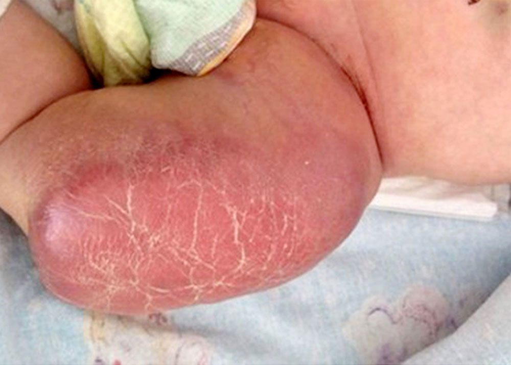 Foto eines Kaposiformen Hämangioendothelioms (KHE) bei Säugling