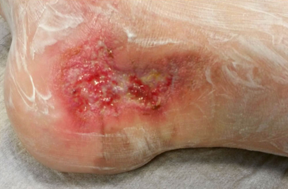 Pseudomonas aerogenosa – Fuß