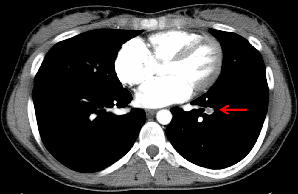 CT – Lungenembolie bei Patientin mit Klippel-Trénaunay-Syndrom