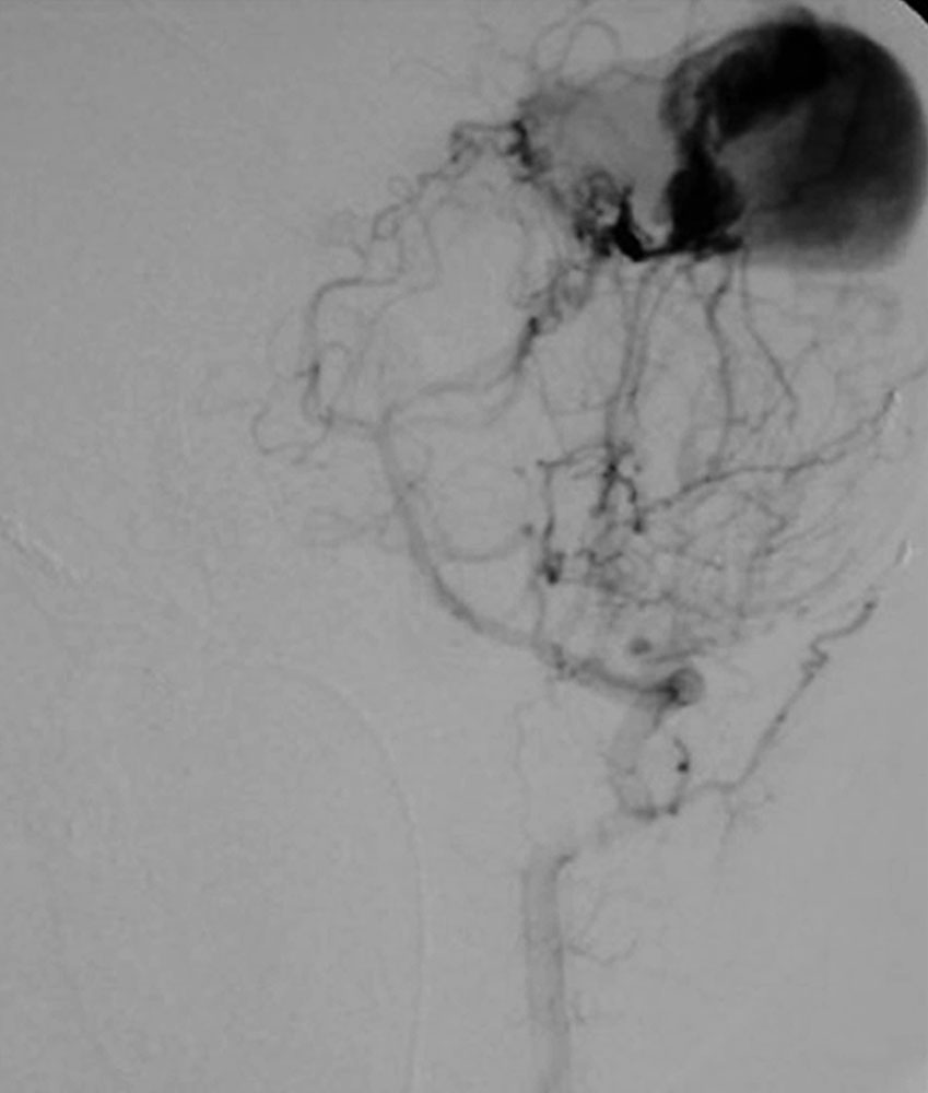 DSA – Riesiges Aneurysma bei Vena Galeni Malformation bei Säugling