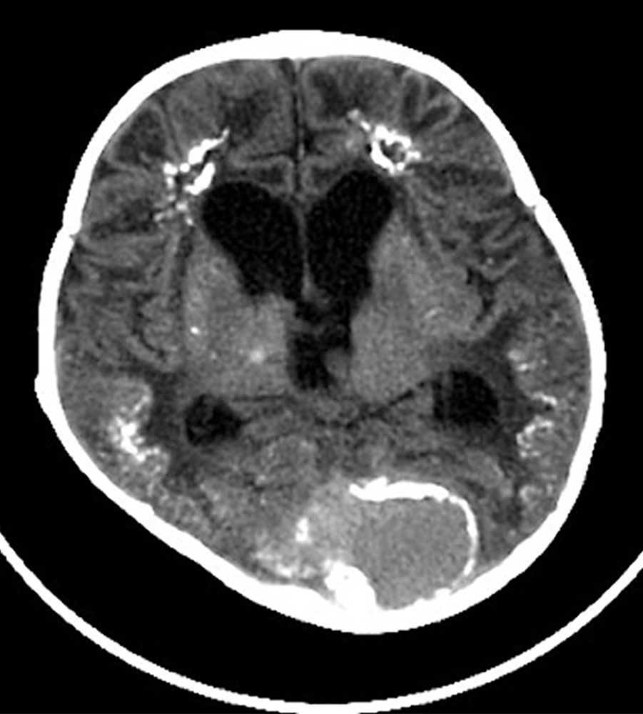 CT – Hydrocephalus, Aneurysma und Verkalkungen bei Säugling