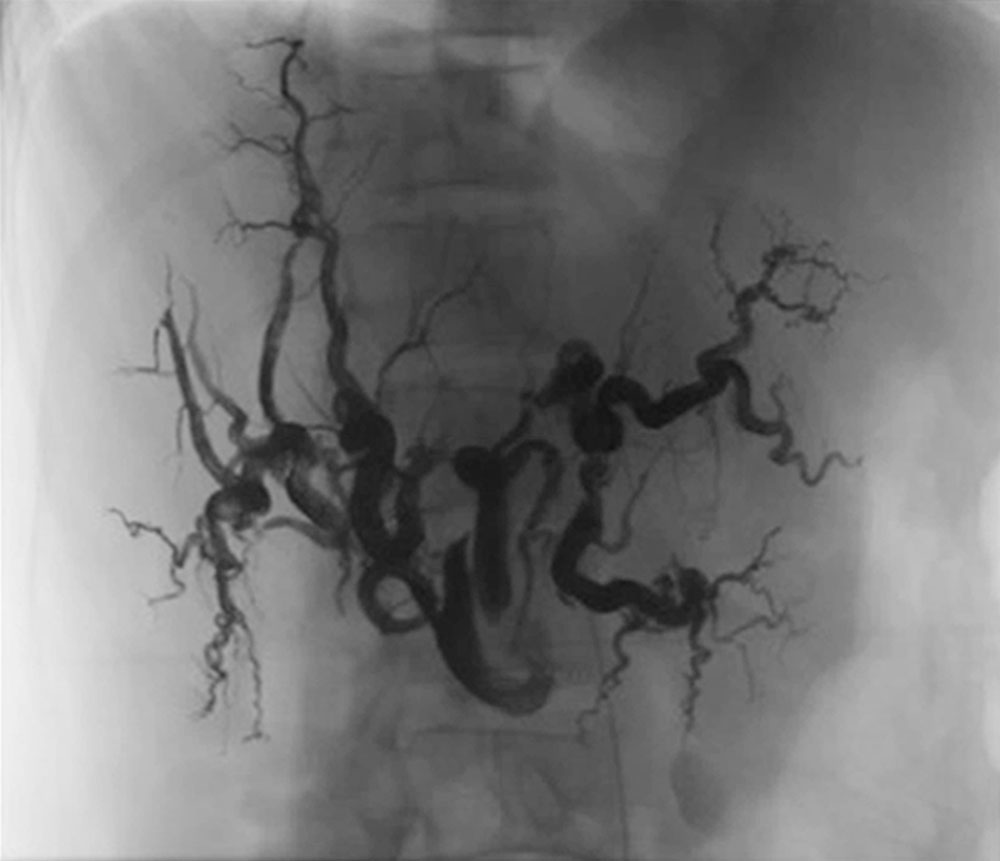 Embolisation einer Leber-AVM bei HHT-Patientin