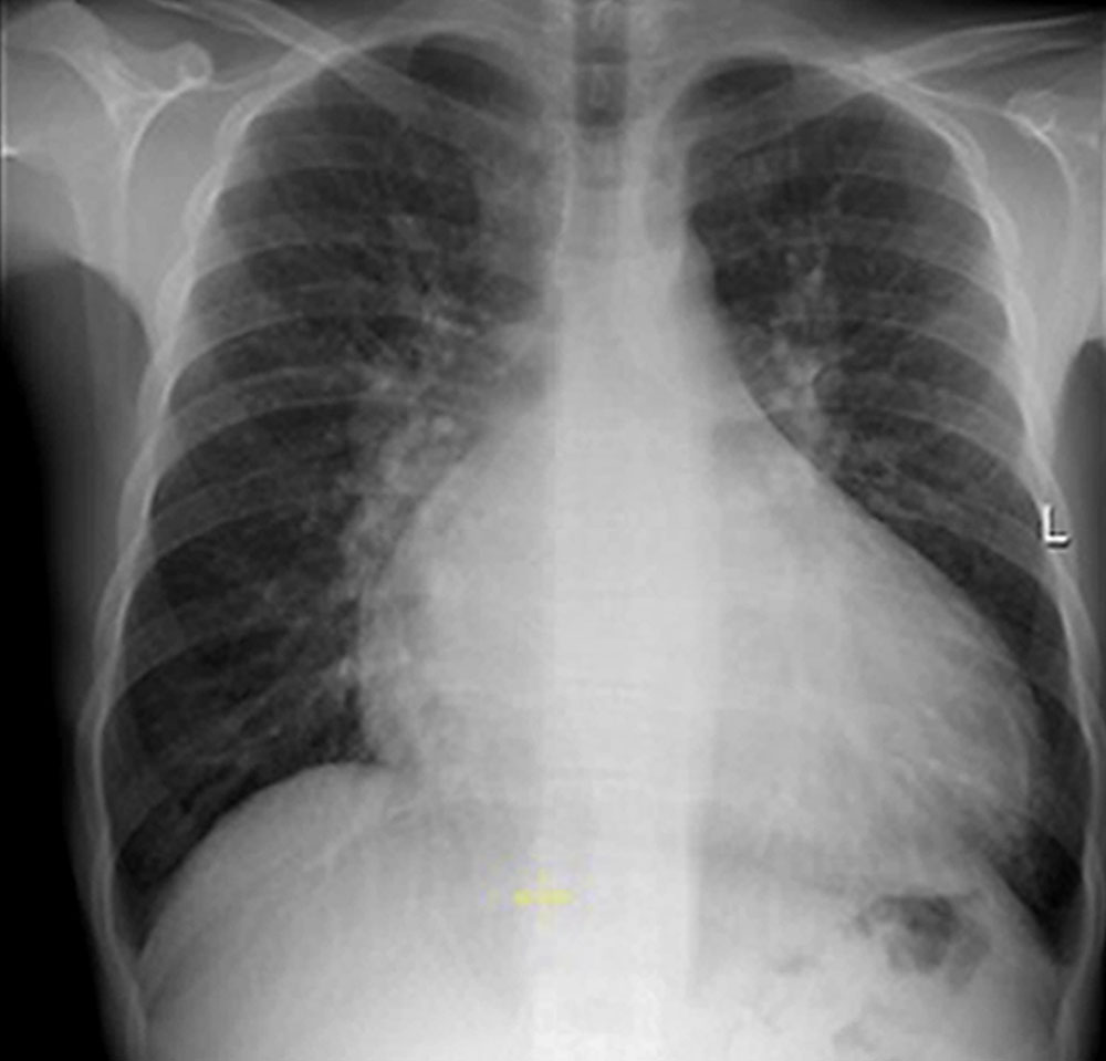 Röntgenbild (Thorax) – riesige abdominelle arteriovenöse Malformation