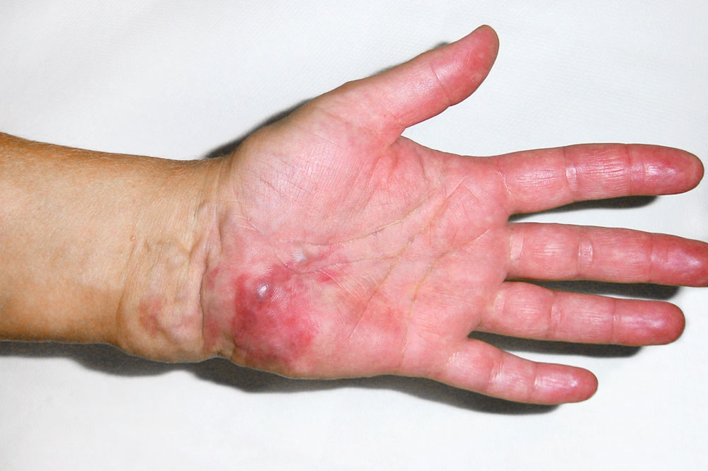 Arteriovenöse Malformation an der linken Hand