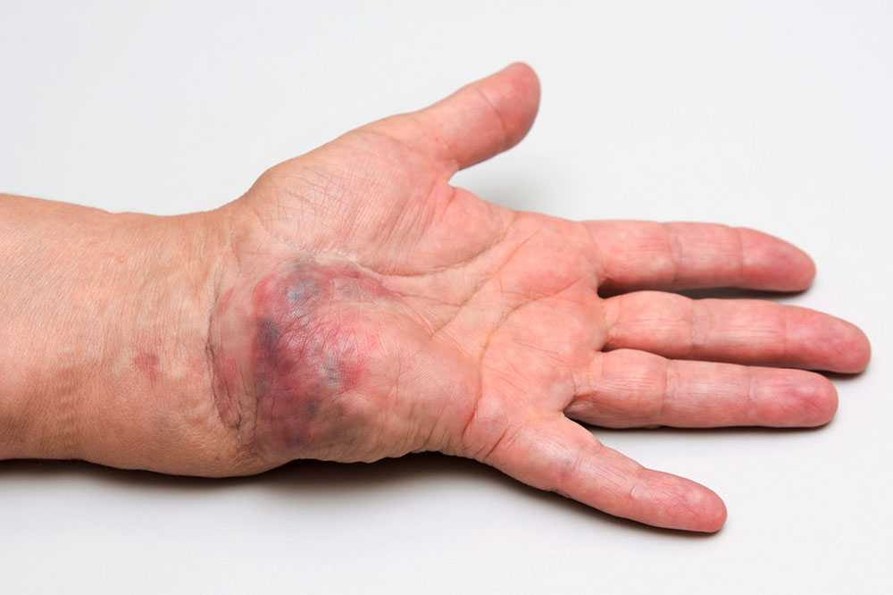 Arteriovenöse Malformation an der Hand – Verlauf nach 10 Jahren