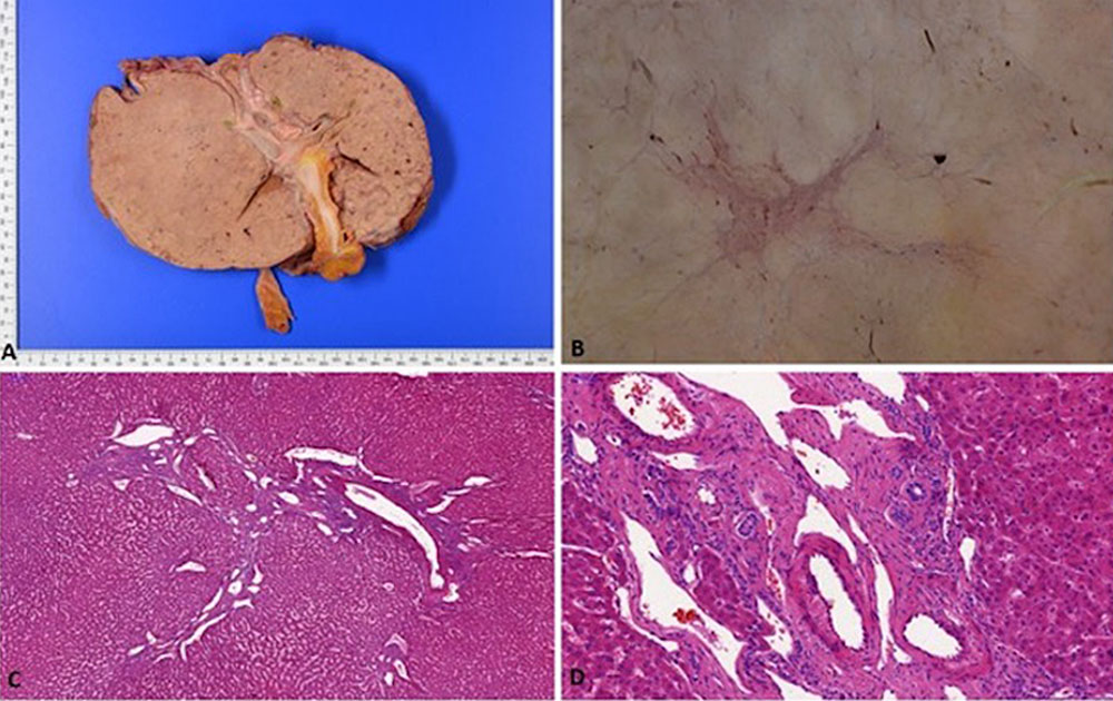 Histologisches Beispiel – Arteriovenöse Malformation der Leber