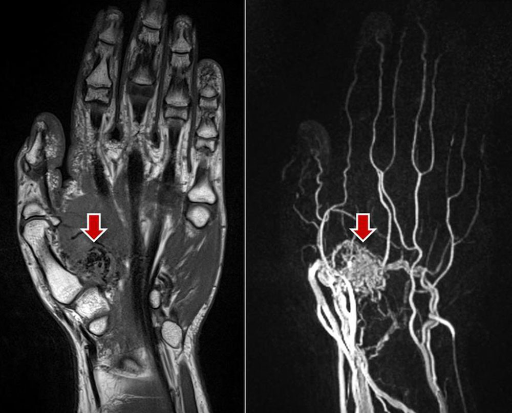 MRT – Arteriovenöse Malformation der Hand