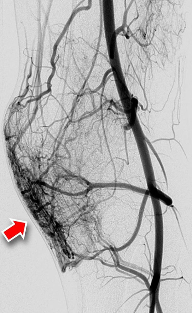 DSA einer arteriovenösen Malformation