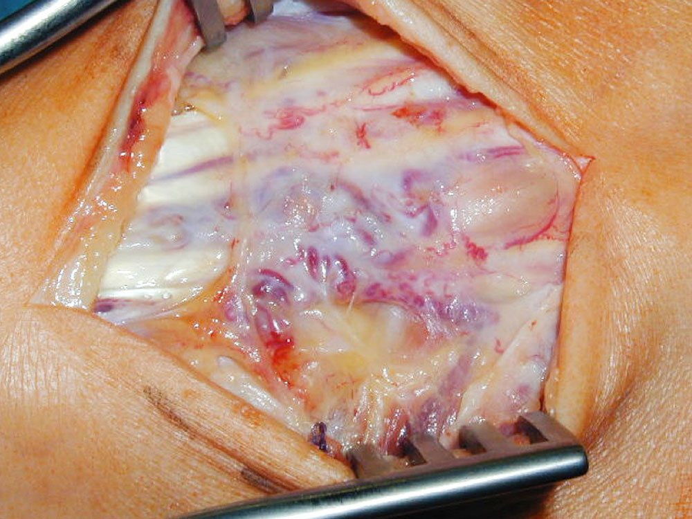 Operationssitus – arteriovenöse Malformation