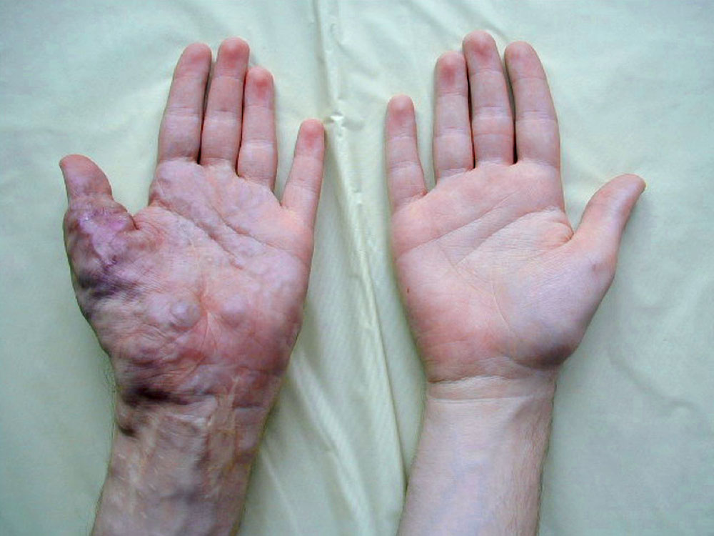 Arteriovenöse Malformation an Hand