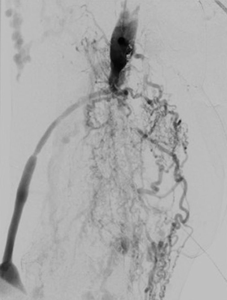 Arteriovenöse Malformation – Bein