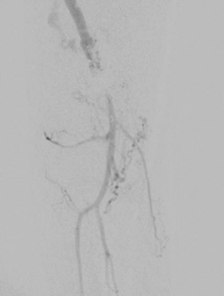 Digitale Subtraktionsangiographie – Bypass