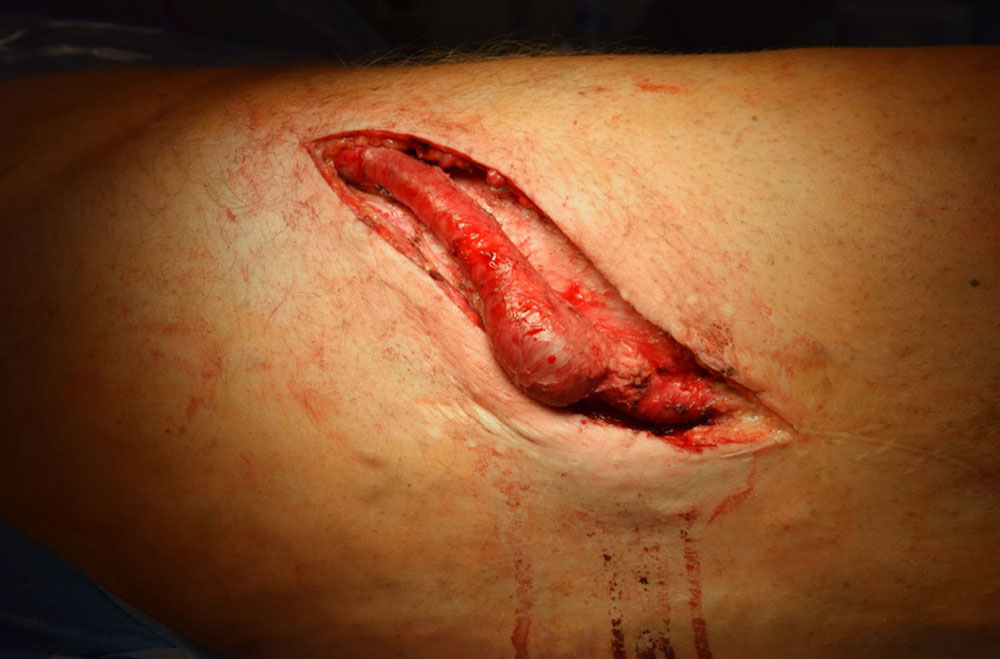 Revisionsoperation – Aneurysma