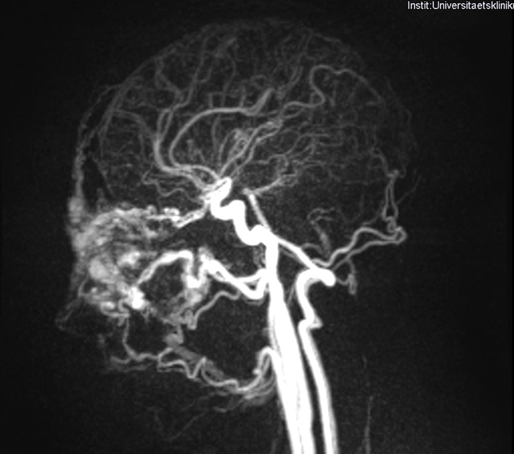 MR-Agiographie der arteriovenösen Malformation vor Operation
