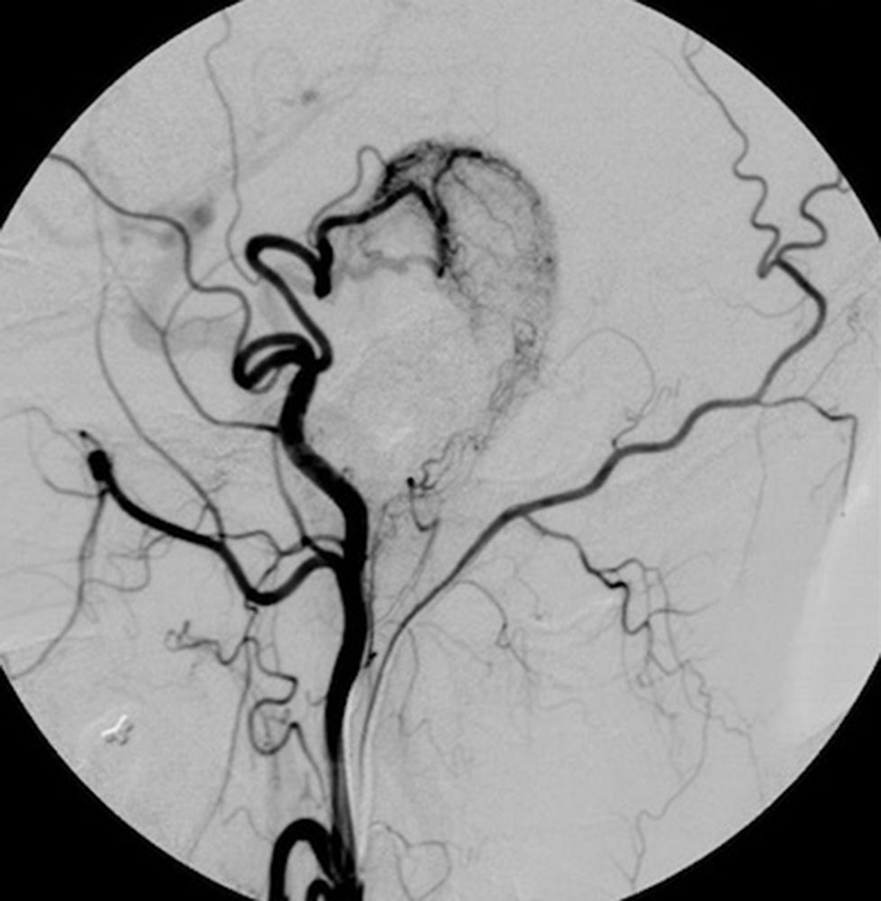 Angiographie präoperativ – Arteriovenöse Malformation