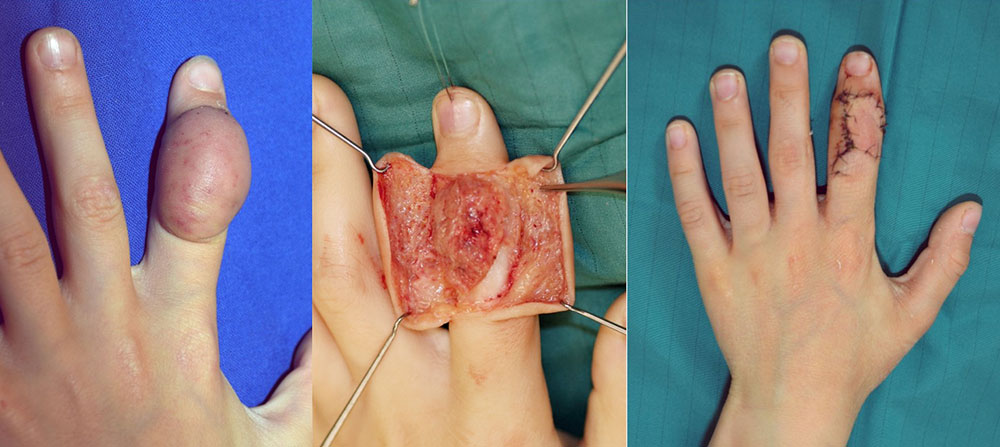 Kombinierte lymphatisch-venöse Malformation am dorsalen Zeigefinger