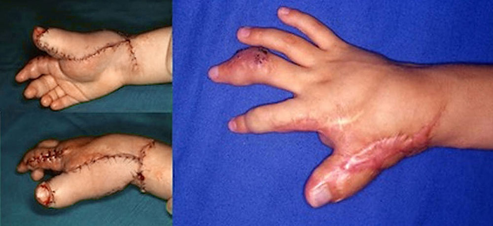 Gemischt venös-lymphatische Malformation an Hand