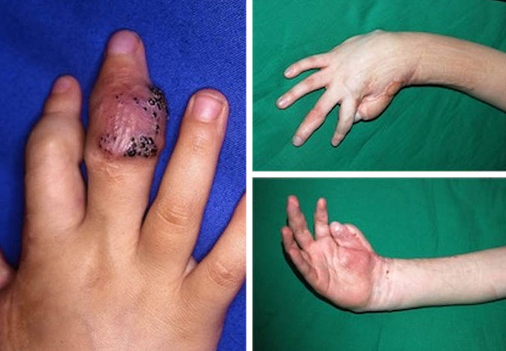 Gemischt venös-lymphatische Malformation an Hand